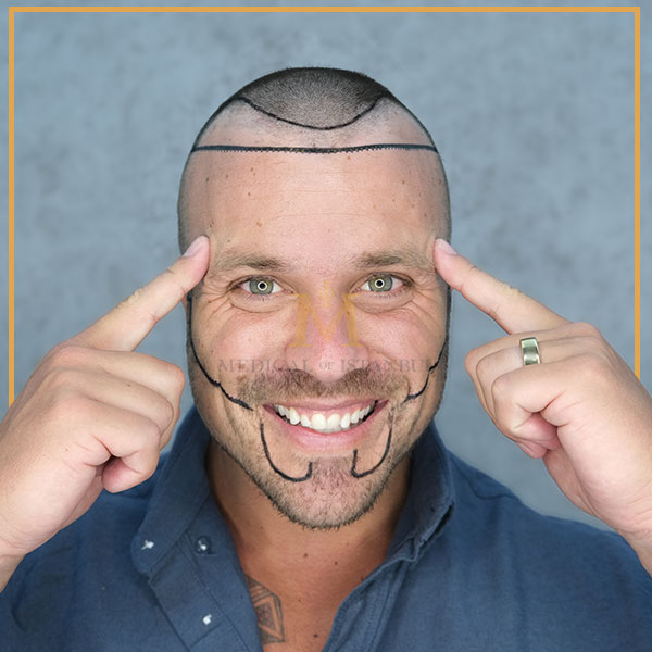 Medical-Of-Istanbul-hair-transplant