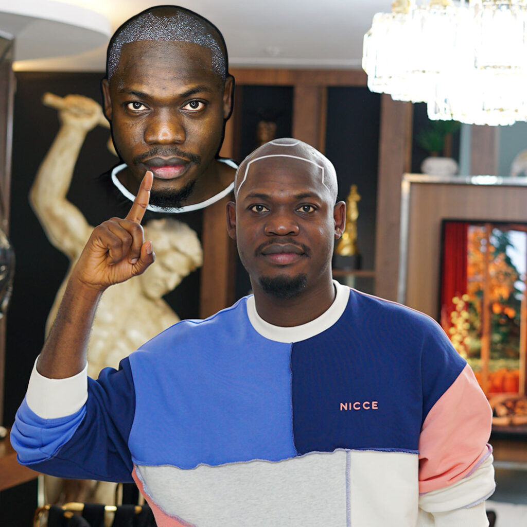 Best-Hair-Transplant-Afro-Hair